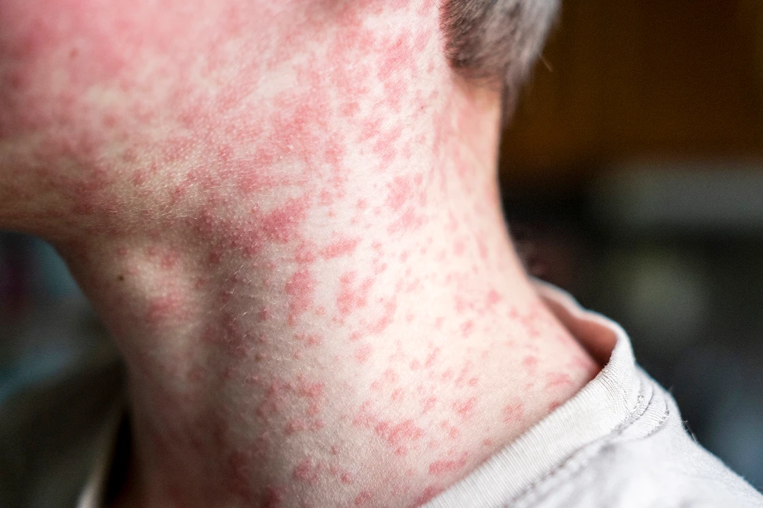 Measles screening image