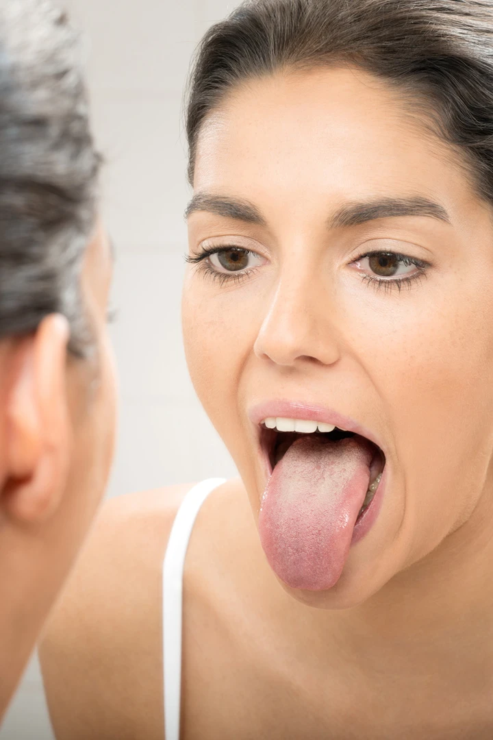 Oral thrush image