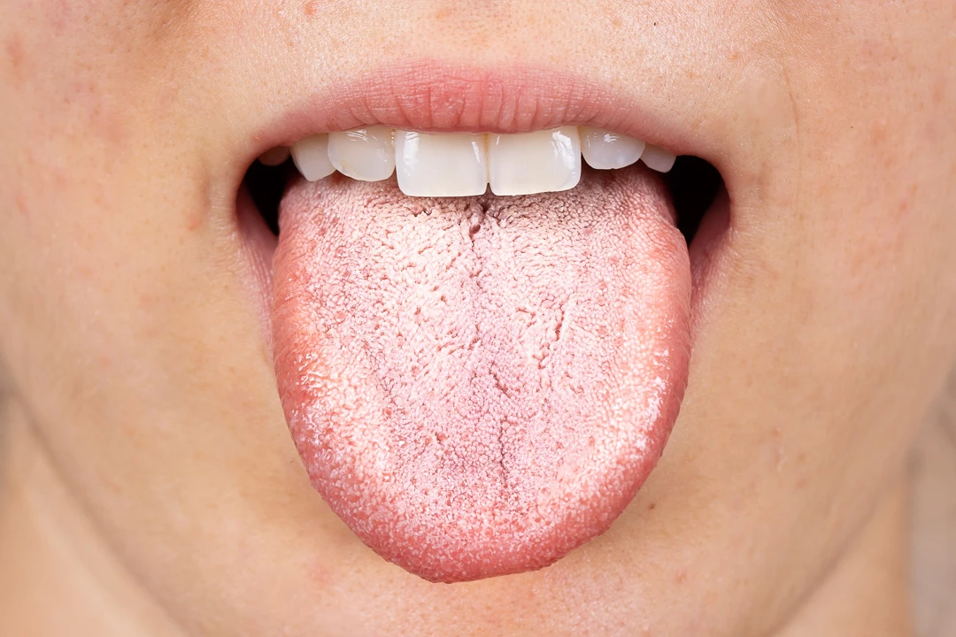 Oral thrush image